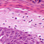 Picture of Metabolic epidermal necrosis